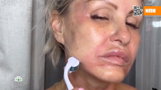 Мифы о пользе ролика с иглами | НТВ | Дзен